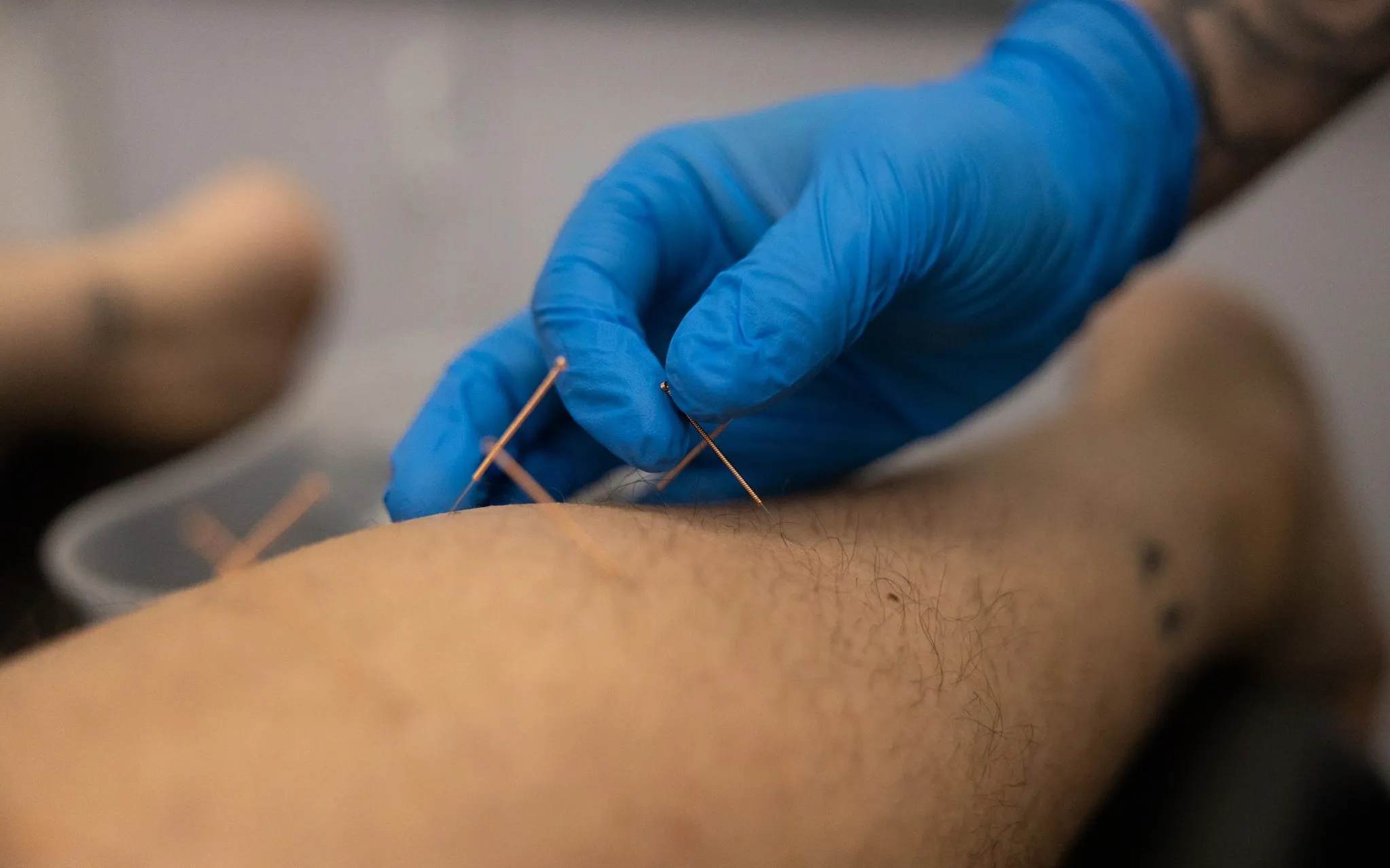 Dry Needling at Olympus Lifestyle Co